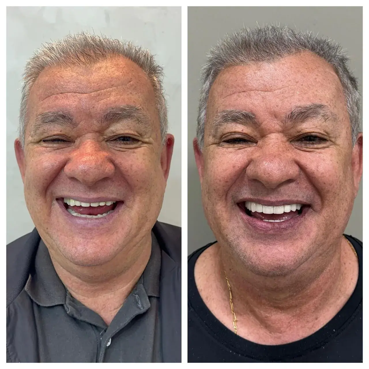 Lentes e facetas dentais: transformação estética do sorriso na Clínica Siso Cianorte