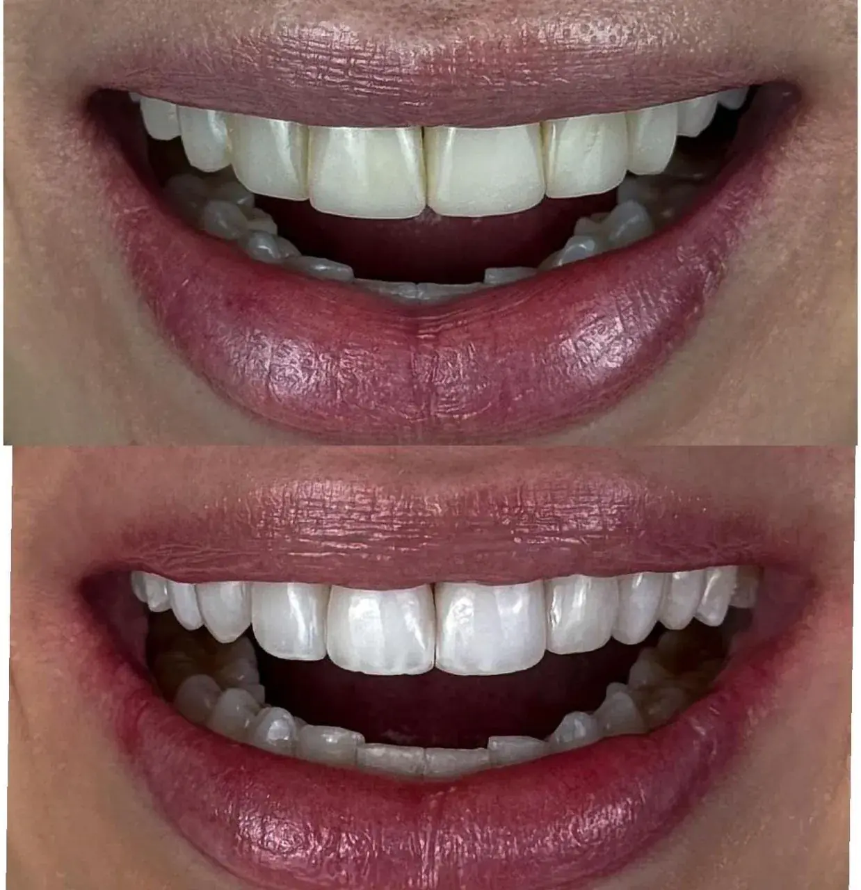 Detalhe de lentes de porcelana aplicadas em paciente da Clínica Siso Cianorte