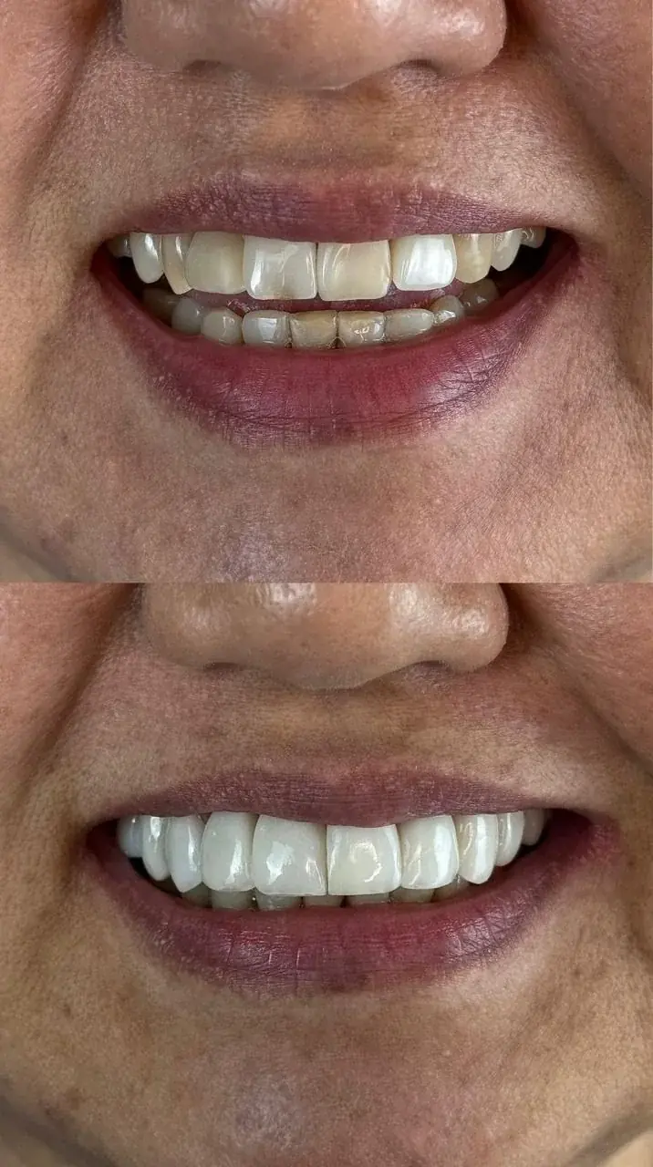 Resultado de facetas dentais em paciente da Clínica Siso Cianorte