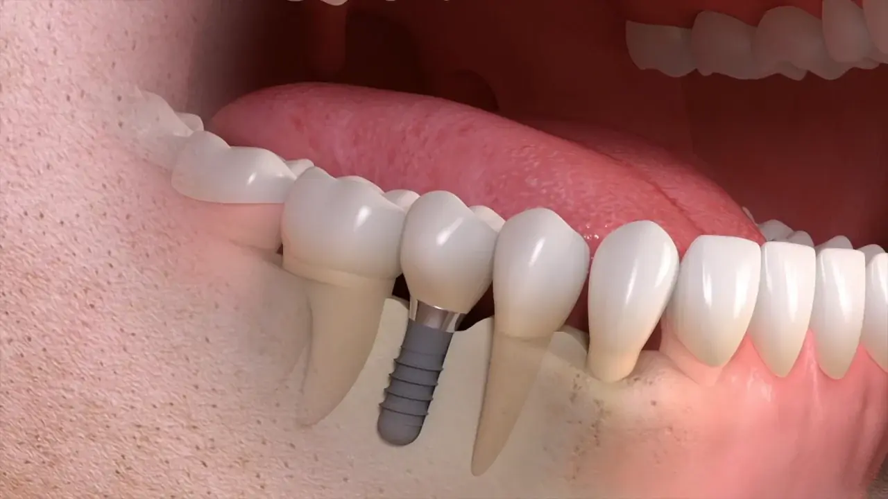 Coroas sobre implante: cerâmica fixada com material estético e resistente
