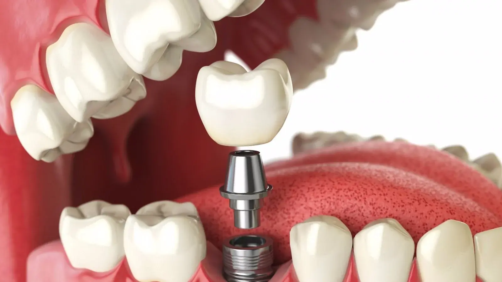 Implantes dentários: estruturas de titânio que substituem raízes dentárias